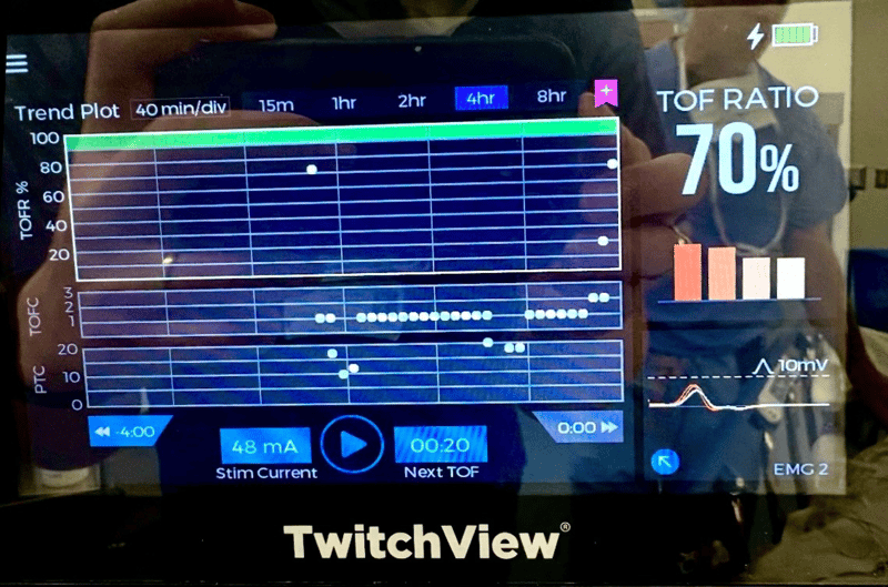 Case Example 2 Four Twitches Doesn’t Mean Full Recovery