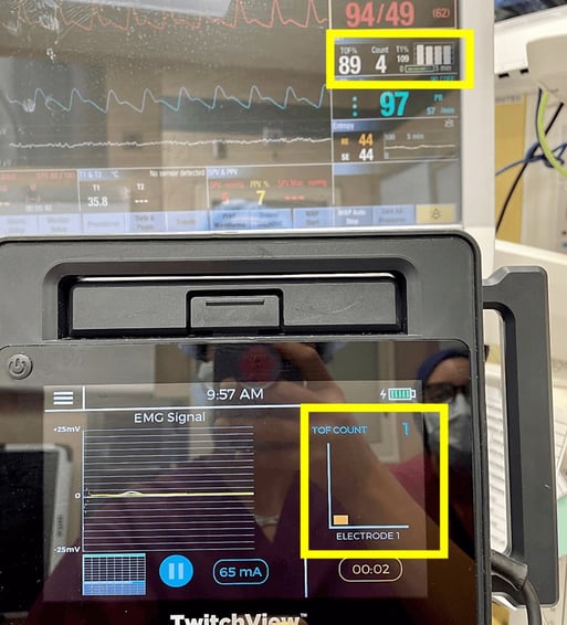 Comparison of Electromyography (EMG) Monitors in Real-Time