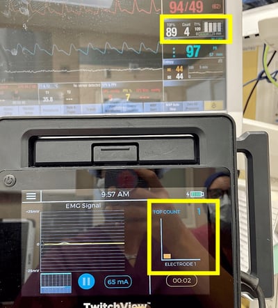 Mechanomyograph used to monitor neuromuscular blockade during general anesthesia