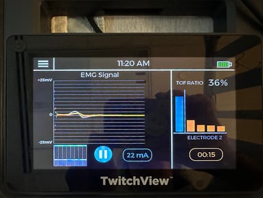  TwitchView train-of-four monitor EMG TOF ratio 36%