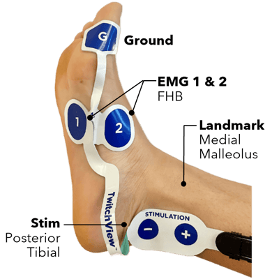 Labeled TwitchView Electrode on Foot-jpg