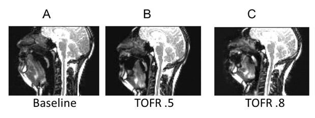 MRI Imaging of Upper Airway Diameter at Baseline and with Neuromuscular Blockade