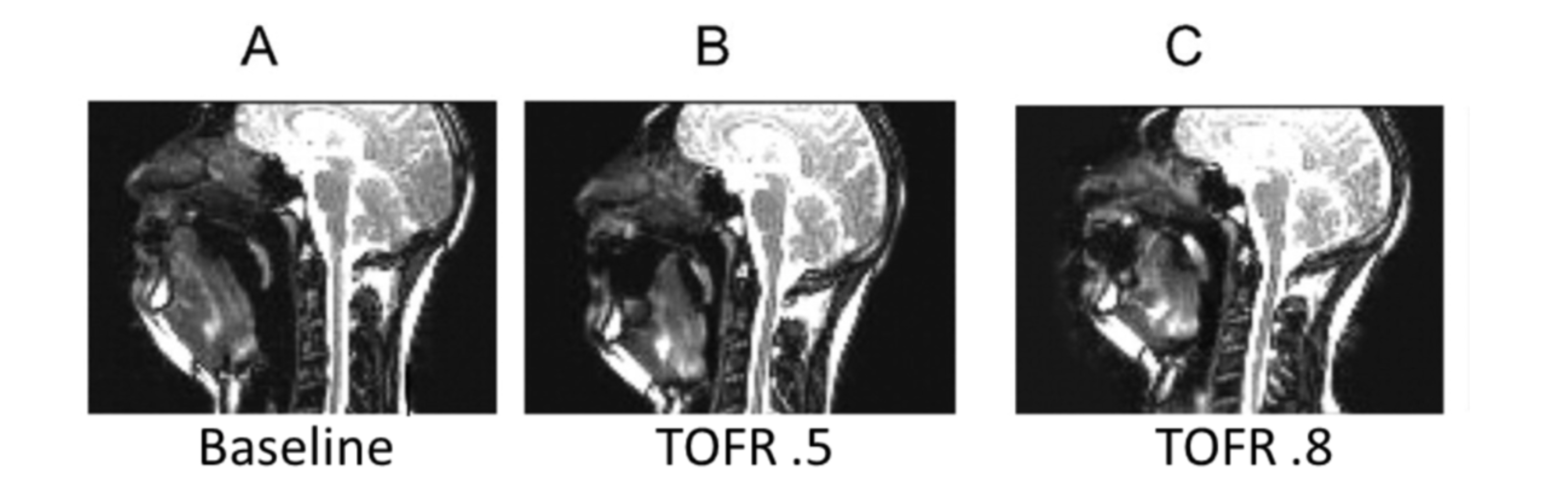Minimum retroglossal upper airway diameter during forced inspiration