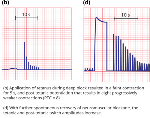 Post-Tetanic Count EMG Tracing During Deep Neuromuscular Blockade Description