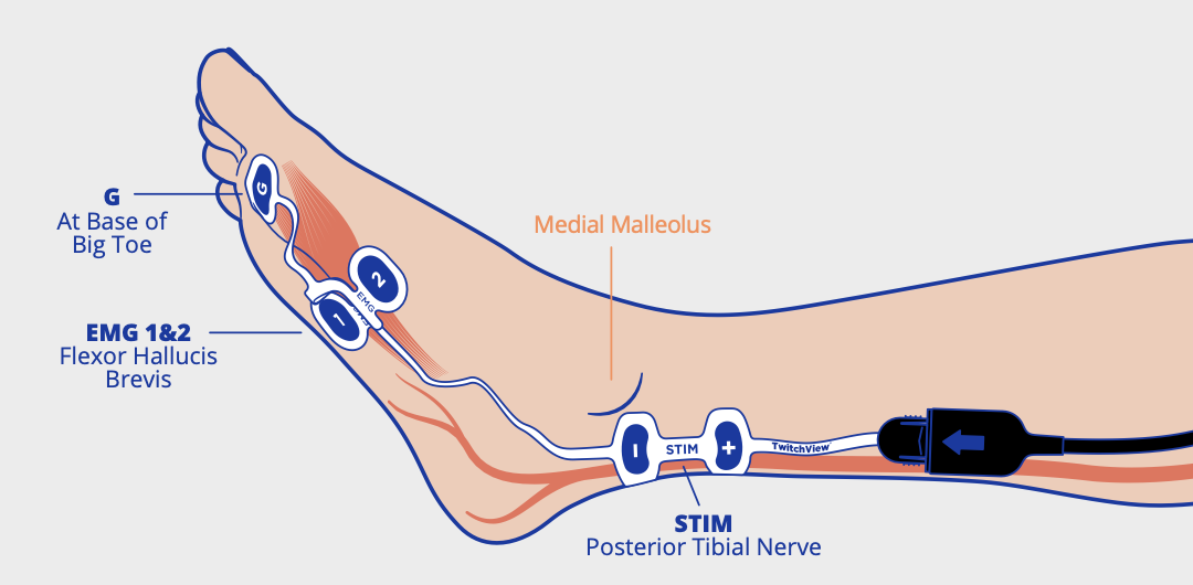 Large electrode placement on foot