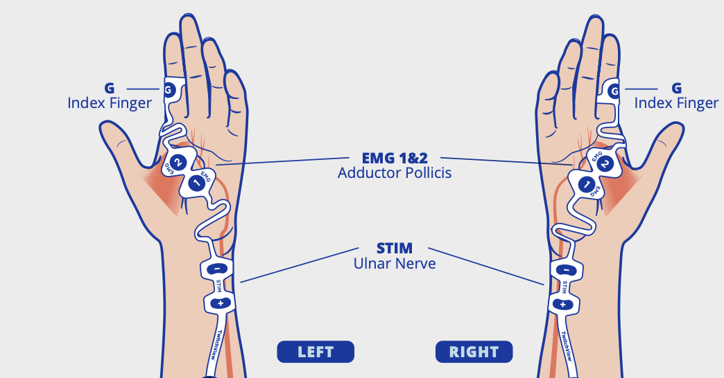 Medium electrode placement on hand