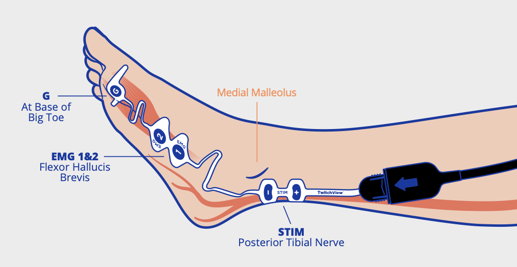 Medium electrode foot placement