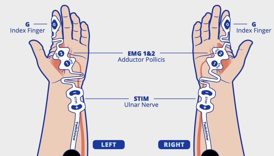 Small electrode placement on hand