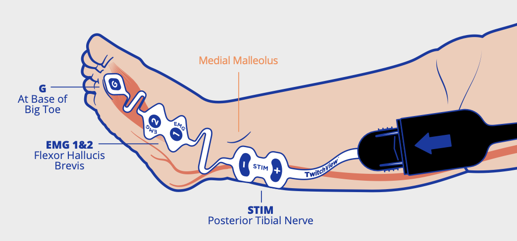 Small electrode foot placement