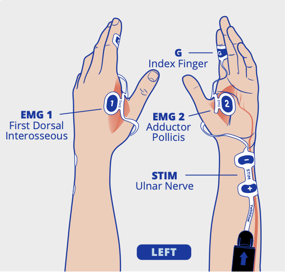 Large electrode placement on left hand
