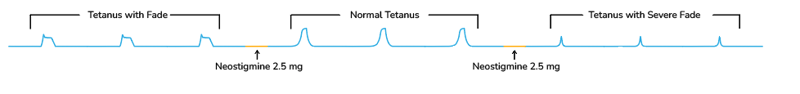 Tetanus and Neostigmine
