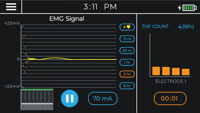Poor EMG Signal Pre Blockade on TwitchView