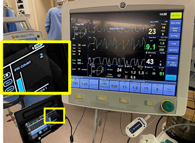 Vent Displays Spontaneous Breathing at PTC 2